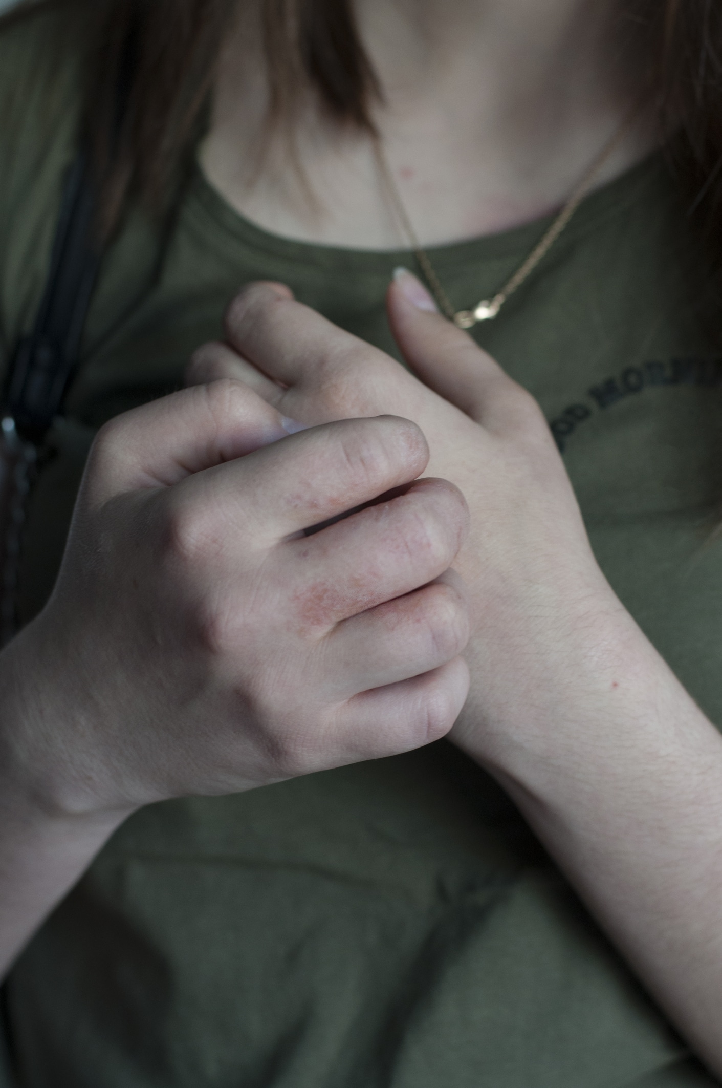 Girl scratching her hands that have a rash