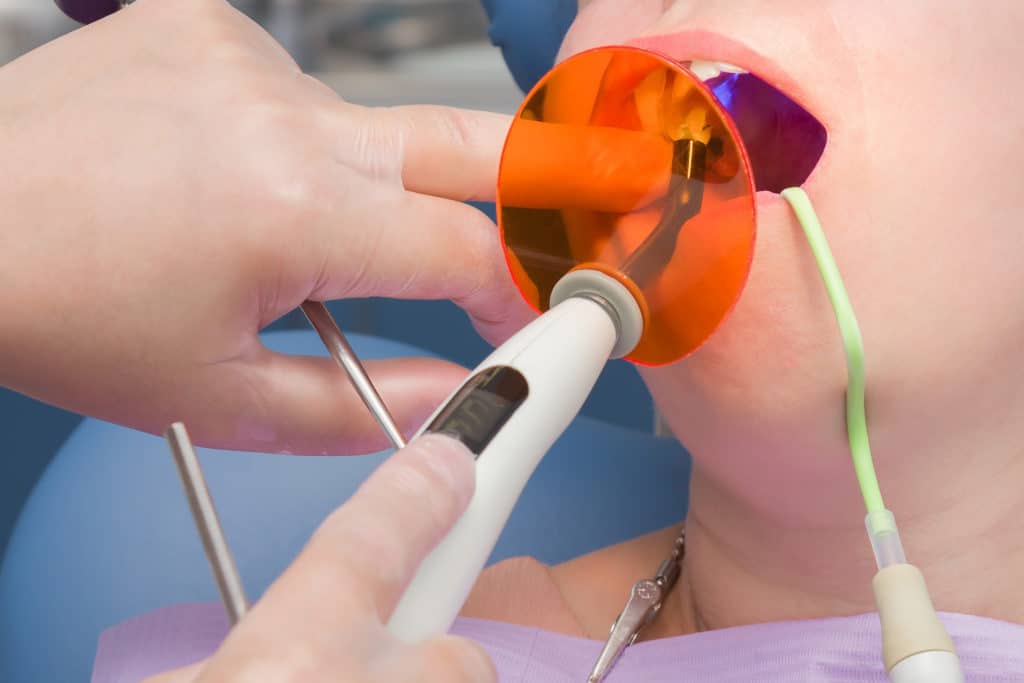 Picture of dentist applying sealant